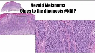 Clues to the diagnosis of nevoid melanoma (NAIP project)