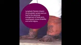 Suma Krishnasastry: revolutionizing care for lymphatic filariasis patients