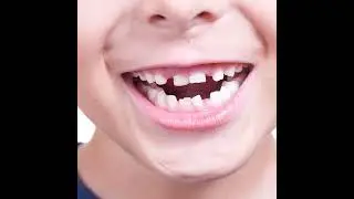 The OPTISMILE Podcast 92 - The Ugly Duckling Phase (Ages 6 to 12): Mixed Dentition