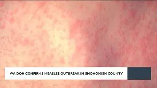 Washington Dept. of Health confirms measles outbreak in Snohomish County