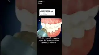 PENGARUH DOT DAN EMPENG DI GIGI
