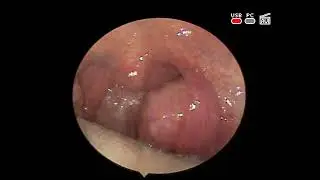 Пухлина лівого піднебінного мигдалика (left #tonsil #tumour) після перенесеного #covid_19