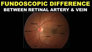 Fundoscopic difference between retinal artery and  retinal vein