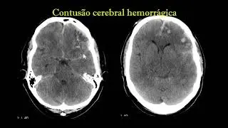 Contus&atilde;o cerebral hemorr&aacute;gica