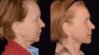 European Face Lift Patient Testimonial: 