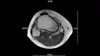 Stress fracture of the tibia - complete MRI examination
