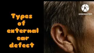 External ear defects , with their names