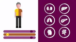 What is Secondary Acute Myeloid Leukemia (sAML)?