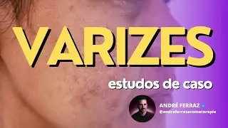 29/05 &agrave;s 20h | VARIZES - Aprenda a tratar de forma natural
