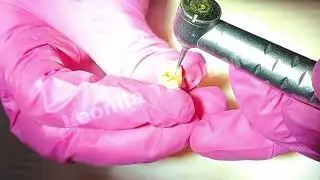 23 24  ENDO ACCESS 2 premolar