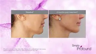 Profound Anti Aging Treatment Clinic in NYC