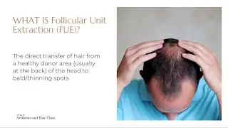 FUE Hair Transplant Surgery in Singapore | What is FUE Hair Transplant?
