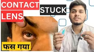 Easiest Way to Remove Contacts | How to Safely Remove Stuck Contact Lenses