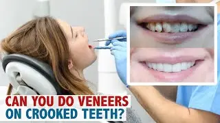 Can you do veneers on crooked teeth ?