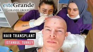 I went to Turkey for a Hair Transplant