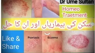 Common skin Disease/Home remedy/face mask/eczema/psoriasis/Ringworm/Homeopathic medicine for skincar