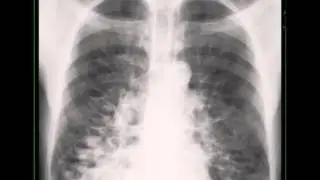 Cystic Bronchiectasis on Chest X ray