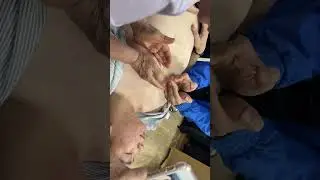 BHTL Bsi CkII Trị liệu tắc sữa