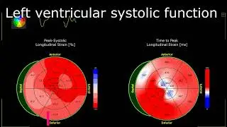 Echocardiography GLS -14% Global Longitudinal Strain Heart Failure EF40% BEFORE Anticancer Treatment