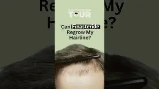 Can Finasteride Regrow My Hairline? | Here's The Answer!