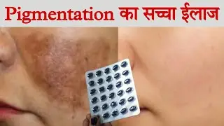 The true treatment for *pigmentation* Dr Reddy Antoxide Hc capsule Remove Pigmentation Dark spots...