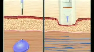 Needle VS Needle Free Injection
