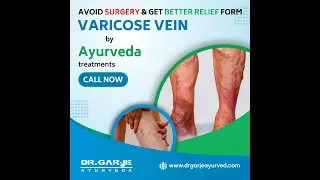 Varicose Vein Treatment Feedback | Surgery Avoided | Natural Healing with Ayurveda | @DrGarjeAyurved