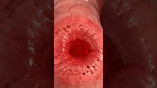 Stomach ulcers: See how the stomach ulcerates from the inside | 3D Animation