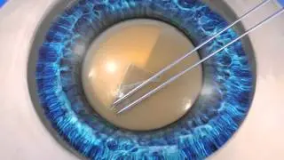 LENSAR Laser Cataract System | Horizon Laser Vision