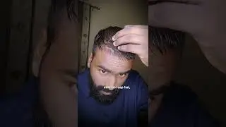 Day 100 ( 100 day hair regrowth challenge)#hairfall #hairregrowthtreatment #hairloss