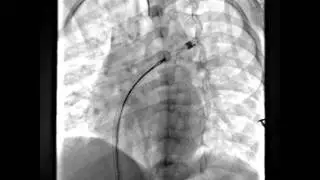 Snare retrieval  of an embolised ADO II  from Left pulmonary artery