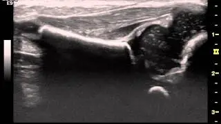 Dynamic Ultrasound Imaging of the Hip in a 2 week-old.