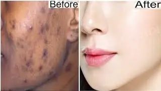IB Glow Ultra Depigmenting Cream Review In Kannada||Remove Pigmentation||Skin Whitening||