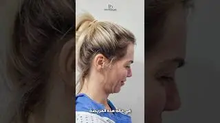 Глубокая подтяжка лица в Дубае | Результаты операции глубокой подтяжки лица | Лучший хирург #коро...