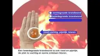 Brandwonden -  Wat moet is de juiste behandeling bij brandwonden?