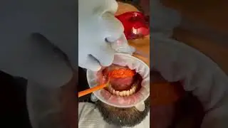 Wonderful dental veneers transformation at Dentatur in Turkey!  #dentatur #dentalveneersturkey