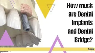 Why Do Implant Prices Vary So Much?