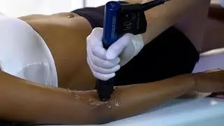 ESWT Tedavi Uygulamaları ESWT Treatment Trigger Points RADIAL / ULNAR EPICONDYLITIS
