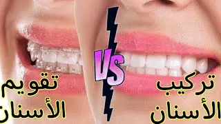 تجميل الأسنان الأمامية | تركيب الأسنان أم تقويم الأسنان