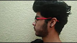 5 meses de minoxidil en la barba