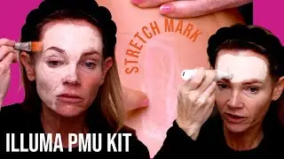 BB Glow & Stretch Mark Treatment with Illuma PMU &ndash; Real Results! ✨💉
