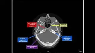 Как читать исследование Brain Bone Window с помощью голоса