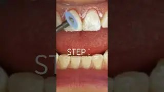 How to Create a Better Polish on Anterior Restorations