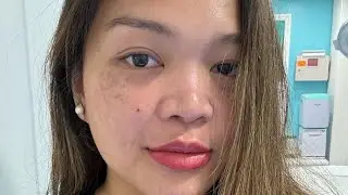 ✨Angels Skinthetics Lip Blush | Before & After Transformation 💋