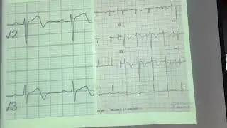 HOW TO APPROACH ECG IN ACTE CHEST PAIN