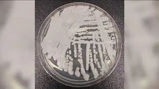 Growing concern over rise of fungal infections in healthcare facilities