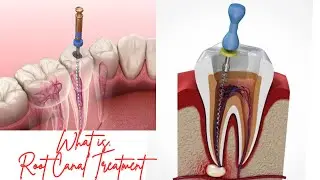 What is Root Canal Treatment|Dental videos|Dental crown|Tooth Pain @siulikbadajena9897 