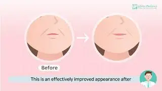 The effect of Threads + Filler