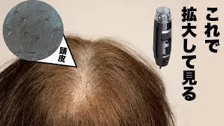 薄毛の人の頭皮をマイクロスコープで除いたら想像を軽く超えてきた