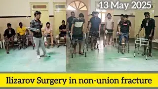 Ilizarov surgery in non-union fracture infection bone #ilizarovsurgery #boneinfection